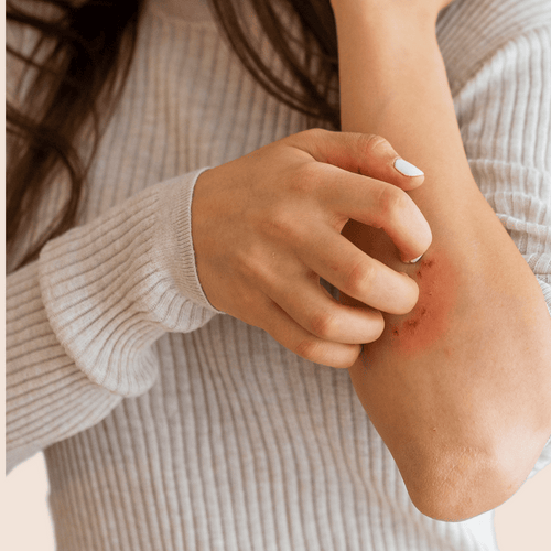 Understanding Dyshidrotic Eczema: Causes and Relief