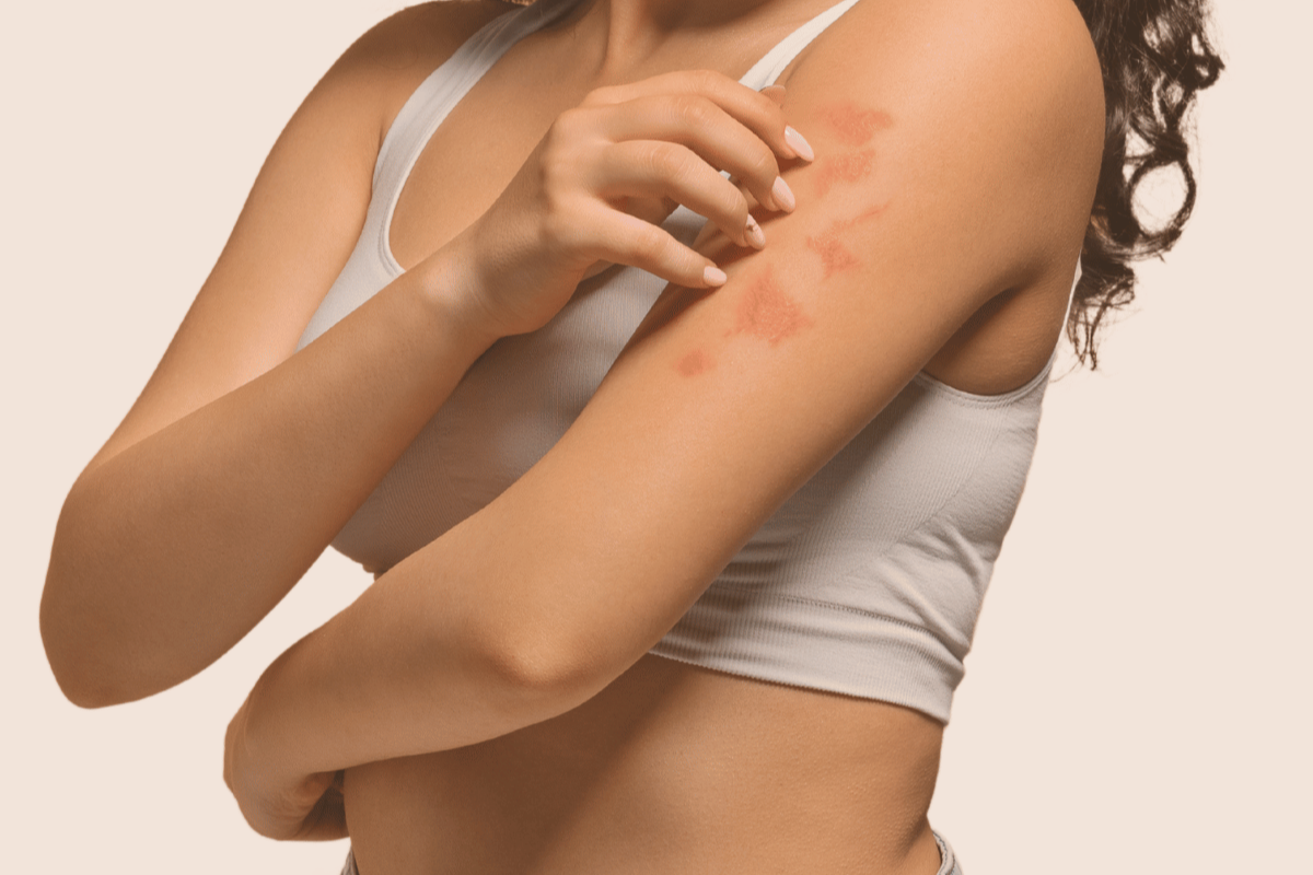 Eczema or Psoriasis? How to Tell the Difference