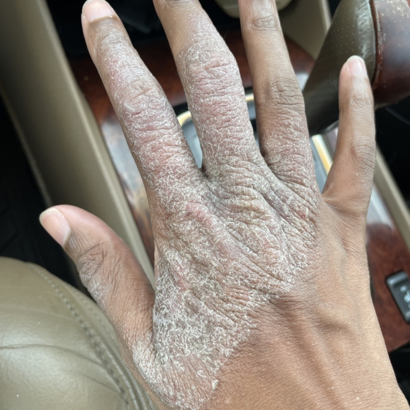 Eczema on Dark Skin: Symptoms and Solutions for Microbiome and Skin Barrier Repair