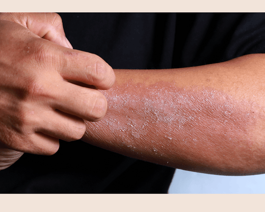 Eczema on Dark Skin: Symptoms and Solutions for Microbiome and Skin Barrier Repair