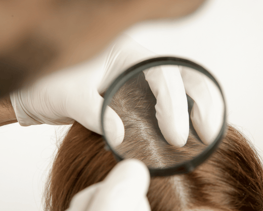 Effective Treatments for Scalp Eczema