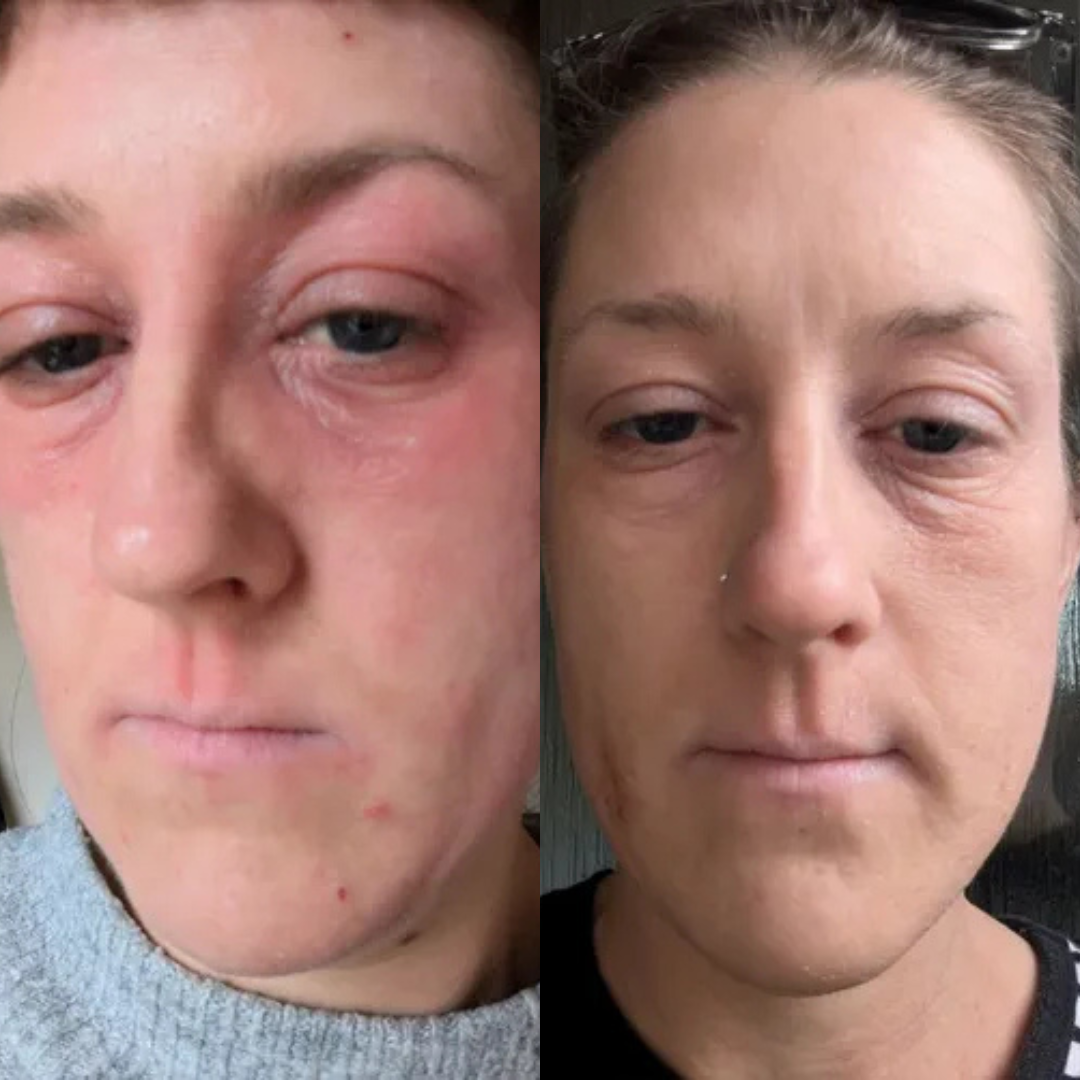 An Ideal Treatment For Sensitive Skin Will Incorporate Best Eczema Treatments For Sensitive Skin